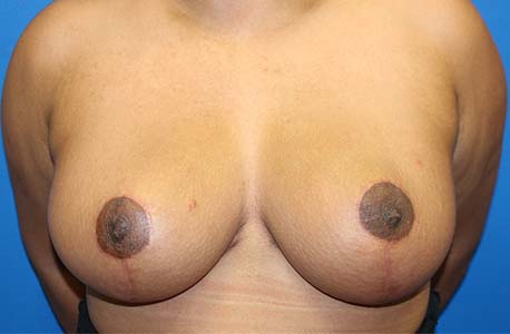 Breast Reduction Charlotte