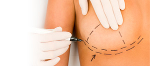 Improve your self-confidence and your bust line with breast augmentation in Charlotte, NC