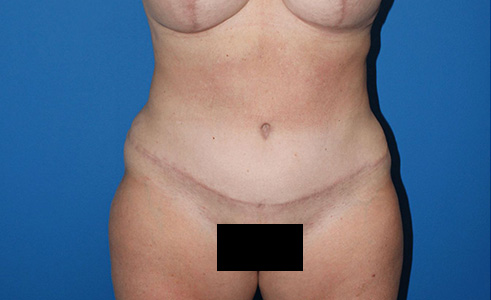 Abdominoplasty Before and After 06
