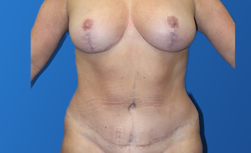 Abdominoplasty Before and After 19
