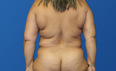 Abdominoplasty Before and After 04