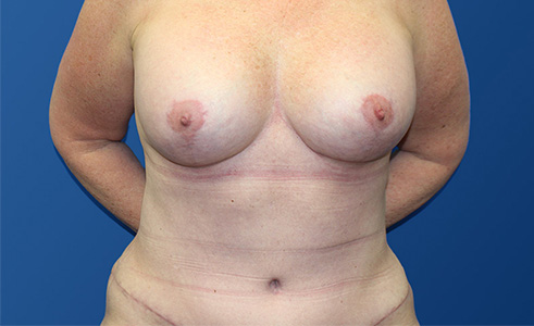 Abdominoplasty Before and After 07