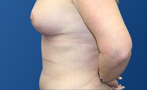 Abdominoplasty Before and After 05