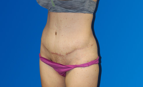 Abdominoplasty Before and After 19