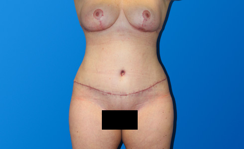 Abdominoplasty Before and After 01