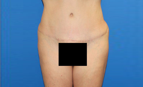 Abdominoplasty Before and After 07
