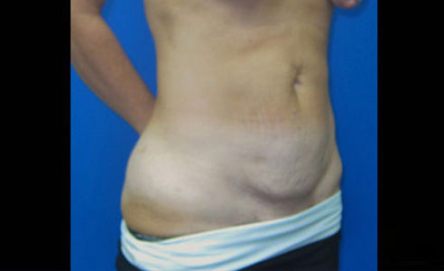 Abdominoplasty Before and After 16