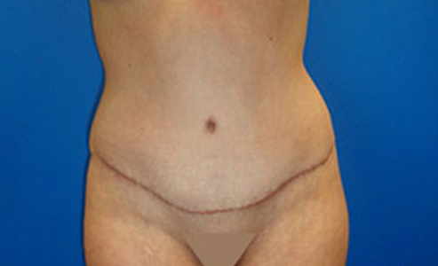 Abdominoplasty Before and After 16