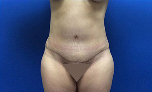 Abdominoplasty Before and After 27