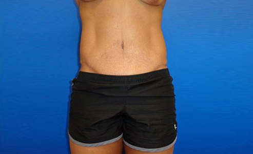 Abdominoplasty Before and After 20