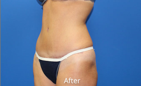 Abdominoplasty Before and After 17