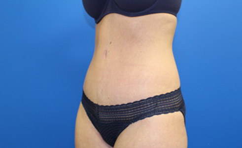 Abdominoplasty Before and After 14