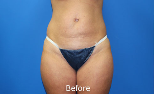 Abdominoplasty Before and After 21