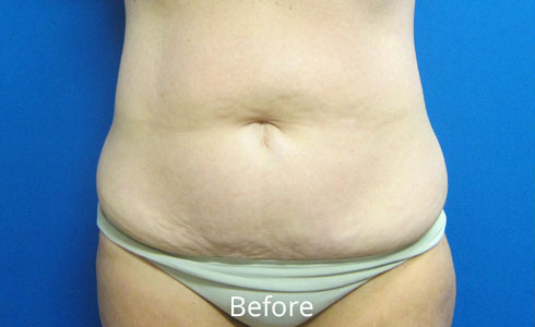 Abdominoplasty Before and After 23
