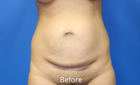 Abdominoplasty Before and After 24