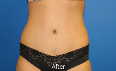 Abdominoplasty Before and After 13