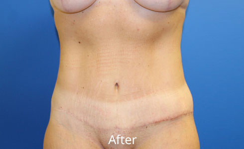 Abdominoplasty Before and After 28