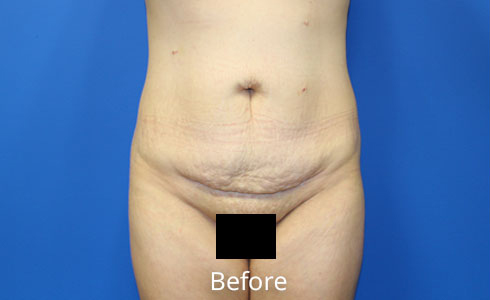 Abdominoplasty Before and After 26