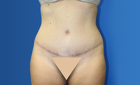 Abdominoplasty Before and After 17