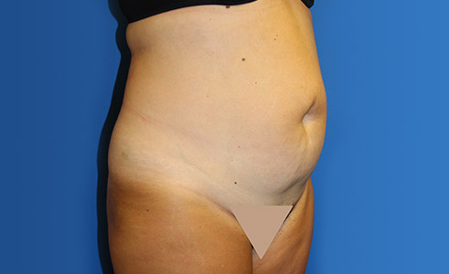 Abdominoplasty Before and After 28