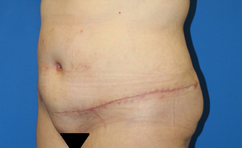 Abdominoplasty Before and After 09