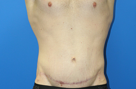 Abdominoplasty Before and After 23