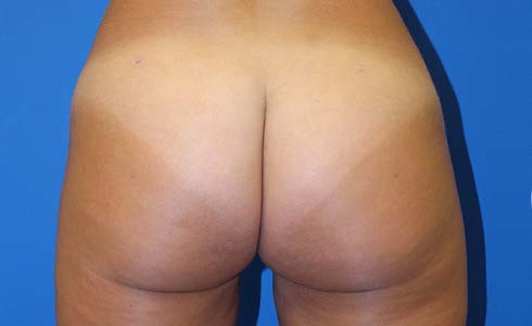 Brazilian Butt Lift Before and After 06