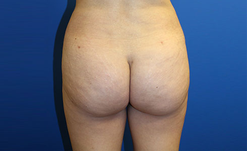 Brazilian Butt Lift Before and After 11
