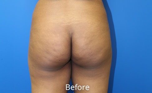 Brazilian Butt Lift Before and After 08