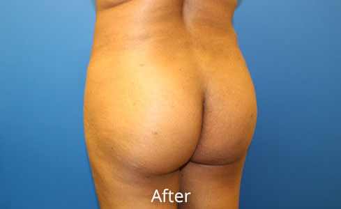 Brazilian Butt Lift Before and After 09
