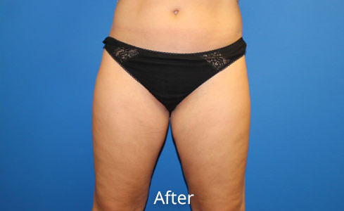 Liposuction Before and After 04