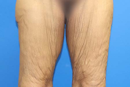 Thigh Lift Before and After 02