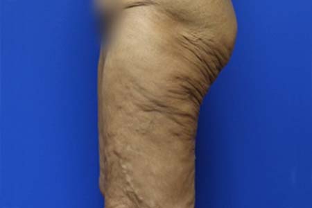 Thigh Lift Before and After 02