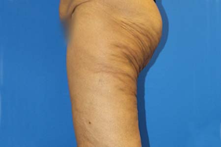 Thigh Lift Before and After 02