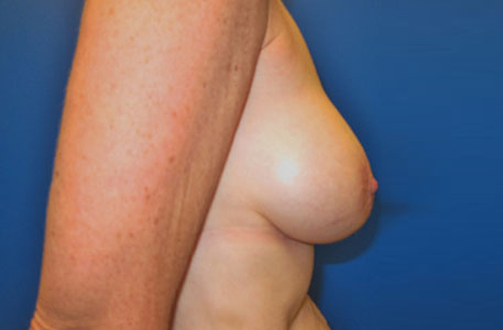 Breast Augmentation Revision Before and After 02