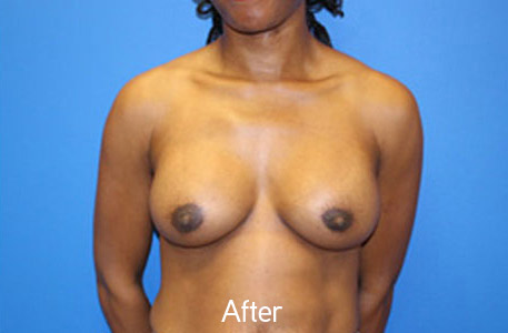 Breast Augmentation Before and After 07