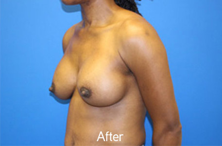 Breast Augmentation Before and After 06