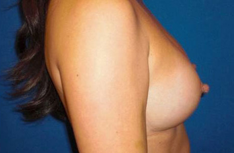 Breast Augmentation Before and After 08