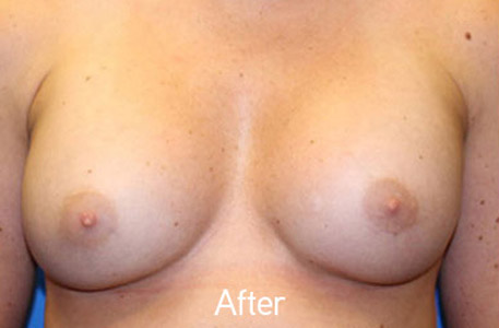 Breast Augmentation Before and After 08