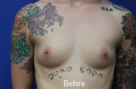 Breast Augmentation Before and After 20