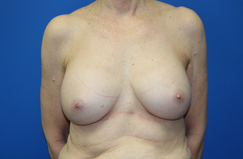 Breast Implant Removal Before and After 04