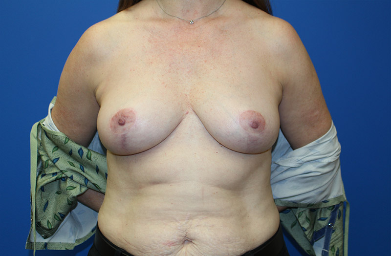 Breast Implant Removal Before and After 05