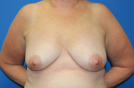 Breast Lift With Augmentation Before and After 01