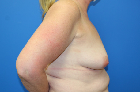 Breast Lift With Augmentation Before and After 01