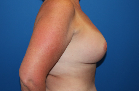 Breast Lift With Augmentation Before and After 01