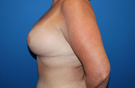 Breast Lift With Augmentation Before and After 01