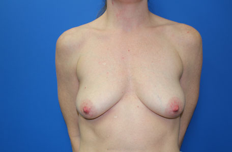 Breast Lift With Augmentation Before and After 02