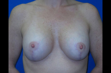 Breast Lift With Augmentation Before and After 01