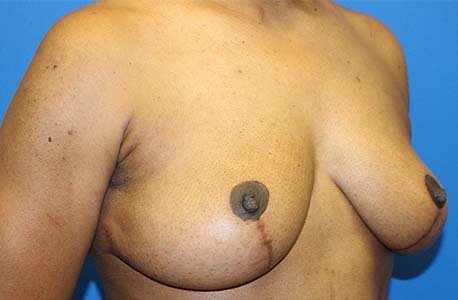 Breast Lift Before and After 02