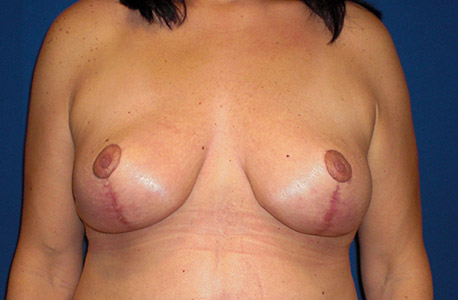 Breast Lift Before and After 05